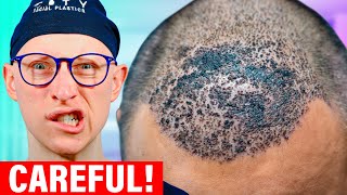 FUE Hair Transplant 4 MONTHS update Istanbul Turkey [upl. by Banyaz]