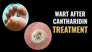 Wart After Cantharidin Treatment [upl. by Eilrahc]