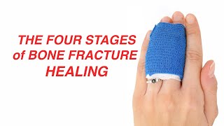 The Four Stages of Bone Fracture Healing [upl. by Minny76]