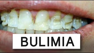 What Bulimia Does To Your Mouth [upl. by Naujed]