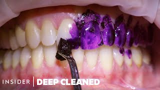 How Teeth Are Professionally Deep Cleaned  Deep Cleaned [upl. by Lobiv]