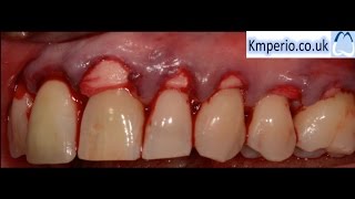 Alloderm Periodontal Surgery for Gum RecessionGraftingRoot CoverageUpper Teeth [upl. by Ardnik48]