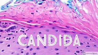 Candida Yeast Infection under microscope Candidiasis Dermatology Dermatopathology [upl. by Sileas]