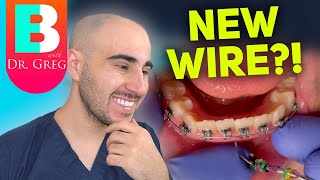 Braces Wire Tightening  Why amp How Your Orthodontist Changes Your Braces Wires [upl. by Noved387]