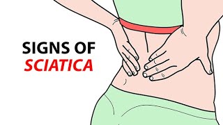 Signs of Sciatica [upl. by Yadnus]