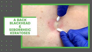 A Back Blackhead amp Seborrheic Keratoses  Dr Derm [upl. by Eihs]