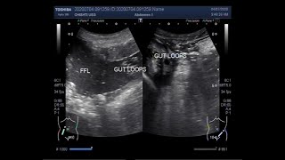 Peritonsillar Abscess Emergency and Needle Aspiration [upl. by Inhoj31]