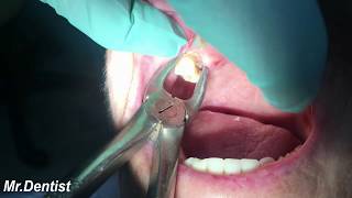 Extraction Of Molar Tooth [upl. by Sorips519]