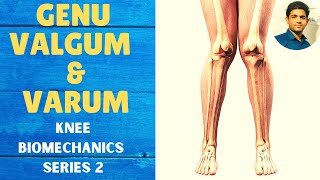 GENU VALGUM amp GENU VARUM  Knee Complex Biomechanics [upl. by Lachman]