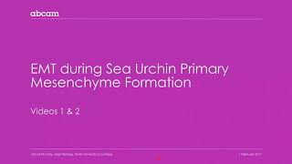 Cancer Epithelial mesenchymal transition EMT 111 [upl. by Leboff484]